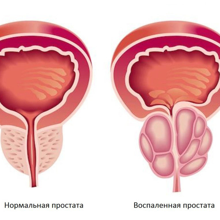 Лечение хронического простатита травами: народные средства