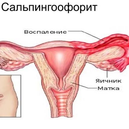 Народное лечение сальпингоофорита травами