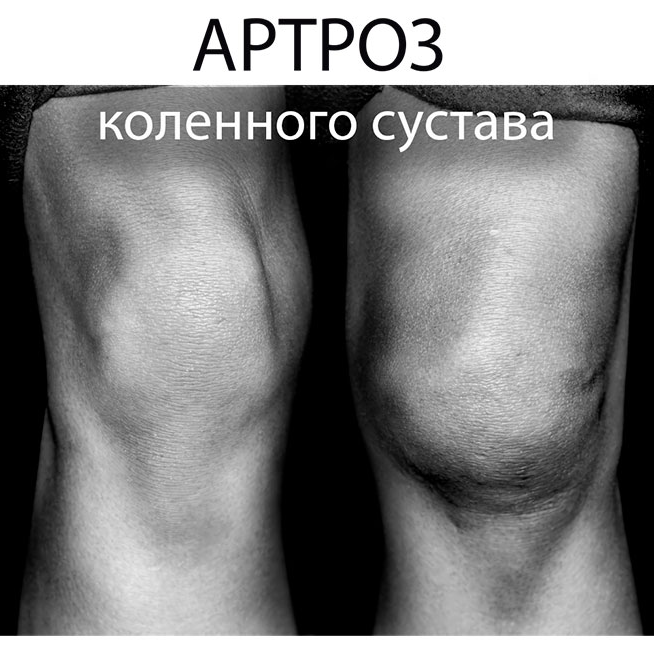 Лечение артроза народными средствами в домашних условиях